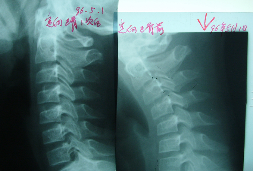 颈椎错位治疗一次后对比