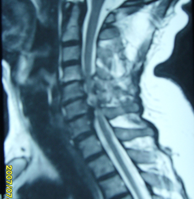 脊髓受压型颈椎病