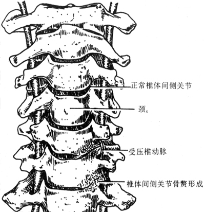 椎动脉受压型颈椎病