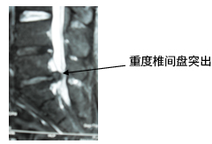 重度椎间盘突出