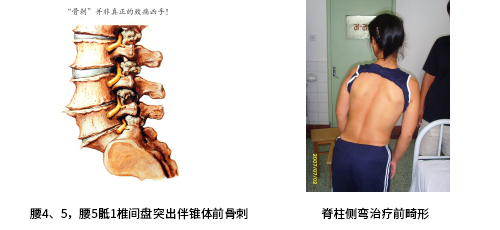 椎间盘突出