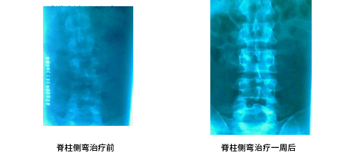 脊柱侧弯治疗