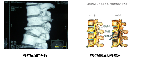 脊柱压缩性骨折